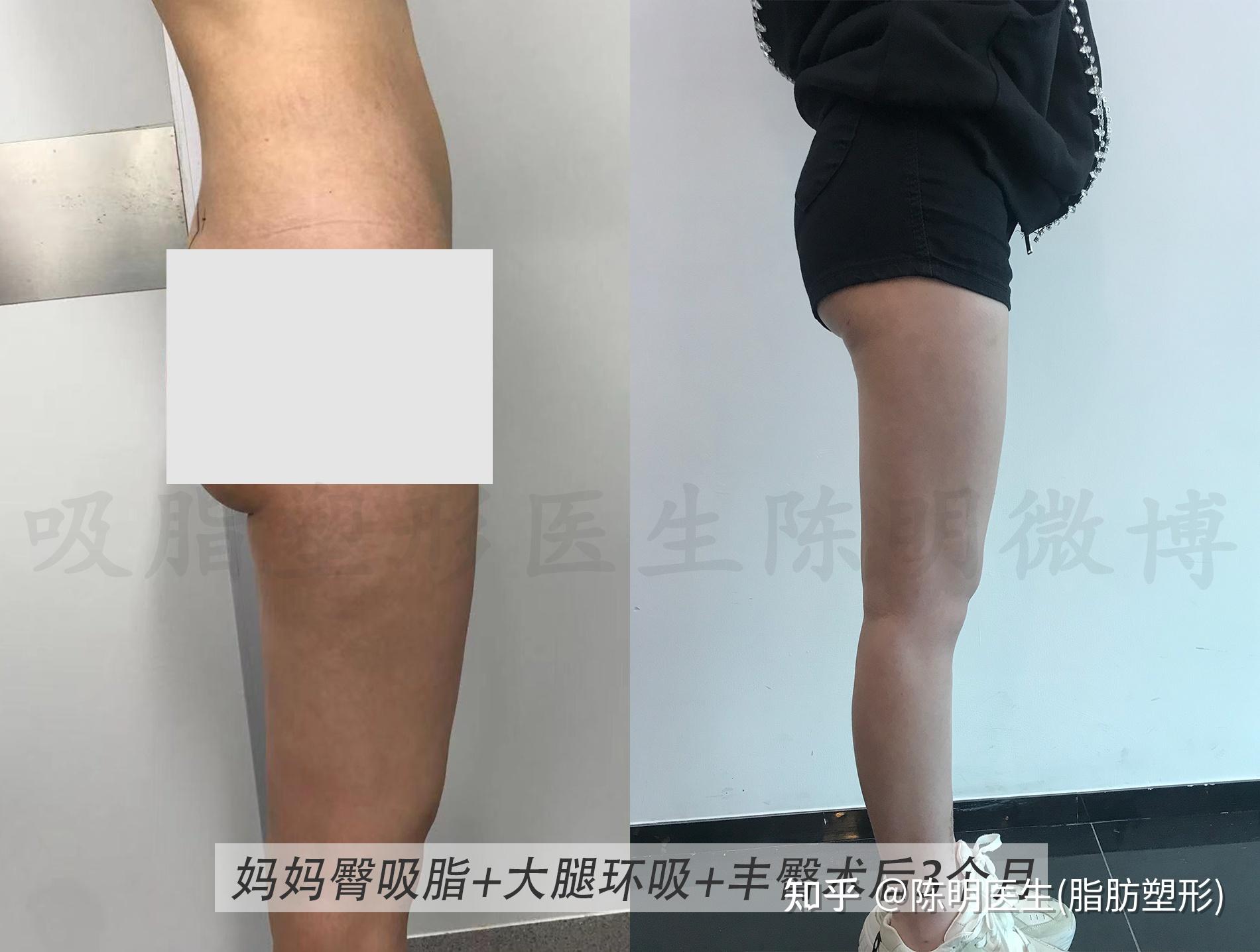 但是局部脂肪堆积明显,术中对大腿环吸 妈妈臀吸脂 丰臀,术后第5天