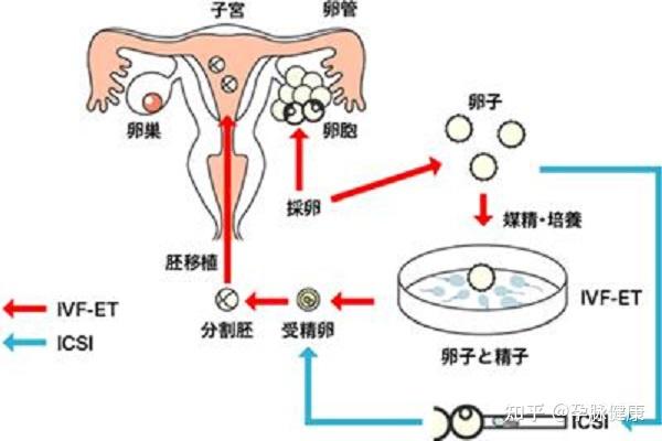 试管婴儿与自然受孕子女认知发展对比