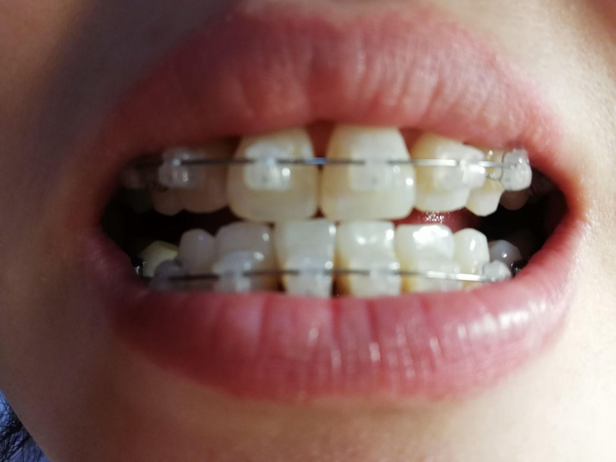矫正牙齿下牙套后戴牙齿保持器是怎样的体验？ - 知乎