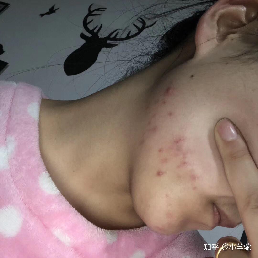 脸上的痘印密密麻麻好多,有没有什么宝藏的去痘印秘籍?