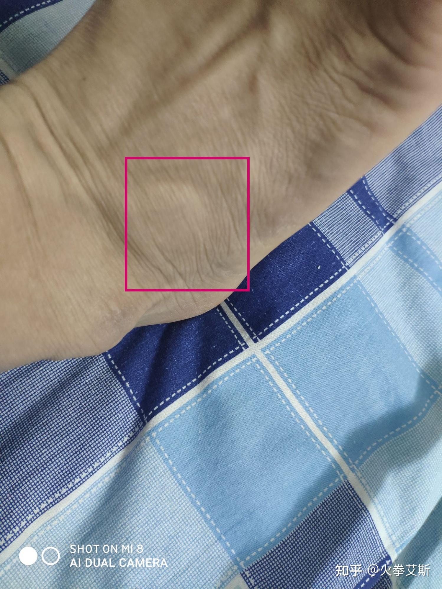 脚上出现莫名其妙的鼓包 有点可怕 求懂医的朋友帮忙诊断下 多谢了?