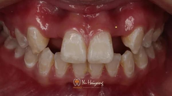 正畸牵引联合氧化锆基台修复双侧侧切牙缺失1例