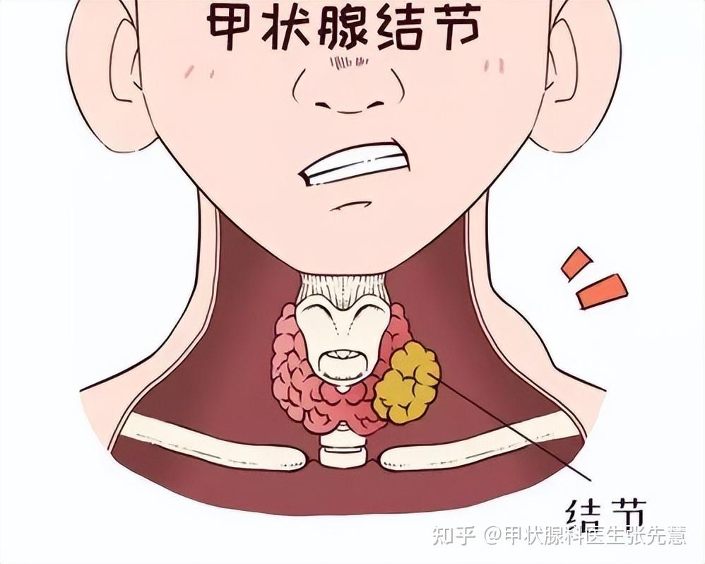 甲狀腺結節不進行手術會消失嗎