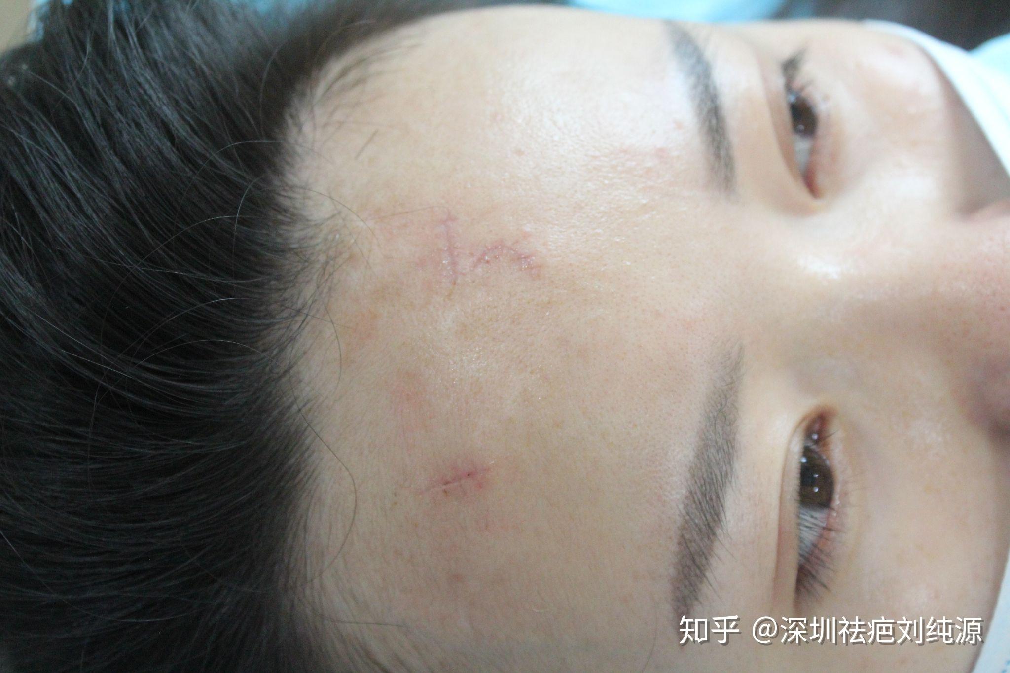 四五年前药水点痣后留下的疤痕还能去得掉么