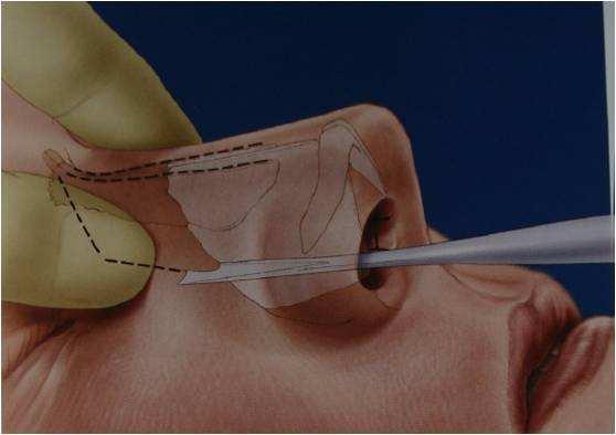 鼻子畸形是否可以在will医院进行鼻翼缩小手术