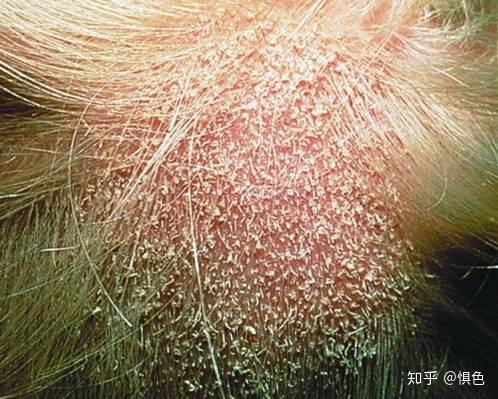皮肤癣菌病 dermatophytosis - 知乎