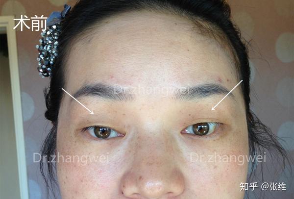 提肌无力与眉眼之间距离过宽怎么美容？