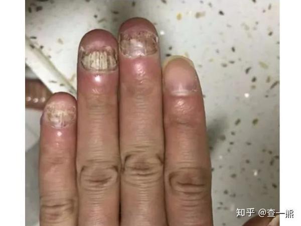 (咨询首图)除食指外,其他指甲均被腐蚀,甲板红肿,并且伴随甲床萎缩