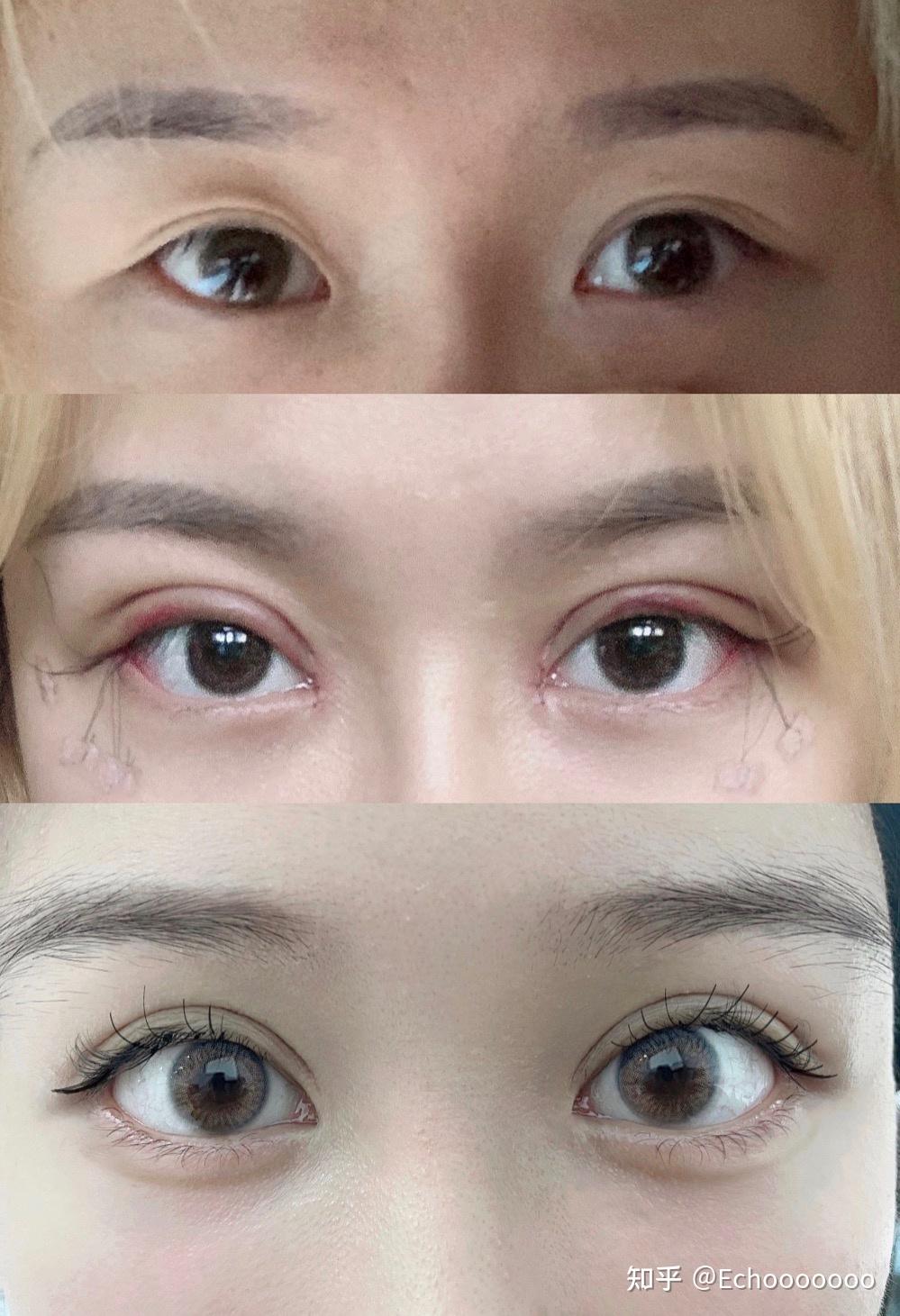 开了外眼角,眼尾的长线固定住做什么用的?