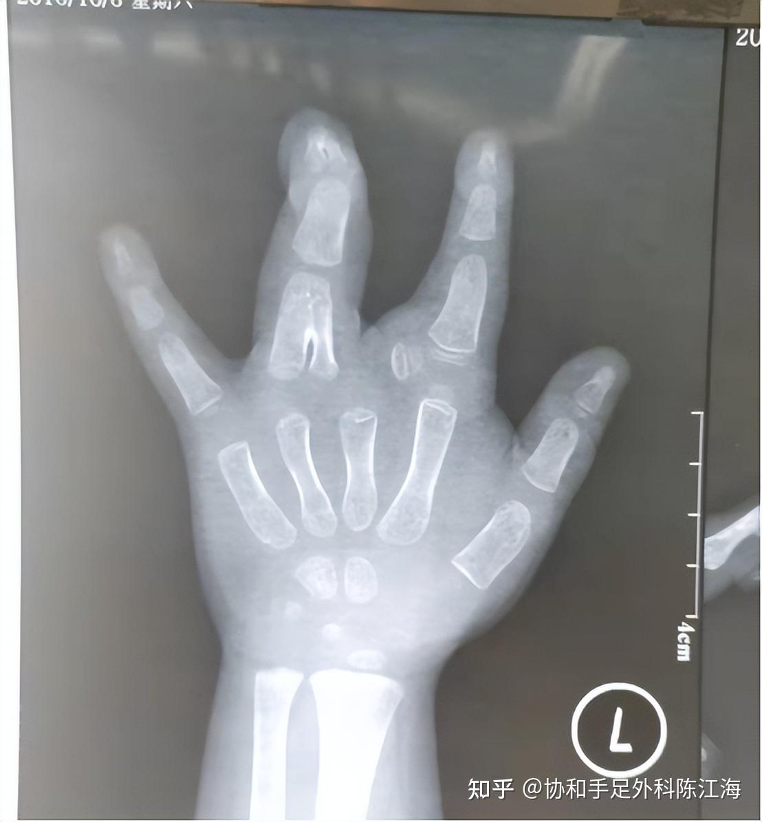 男孩只有四根手指,一根却非常粗!到底为什么...... - 知乎