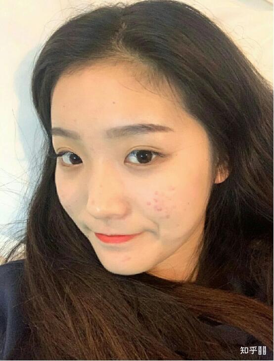 有什么办法能让痘印消失