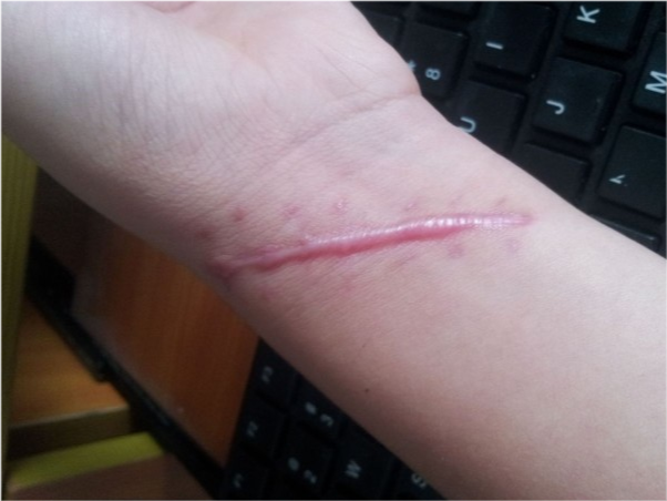 【长春肤康皮肤】疤痕鼓起来怎么处理比较好 - 知乎