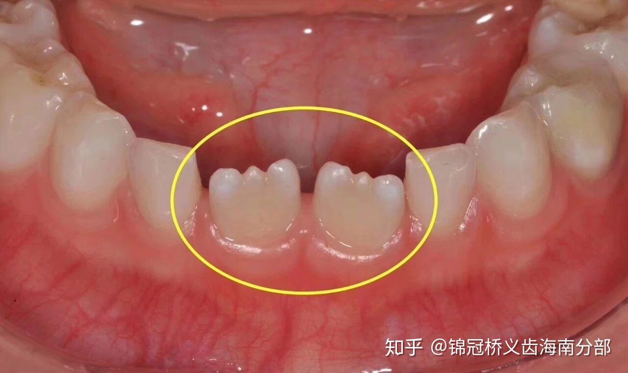 锯齿状牙常见于上下前门牙和侧切牙,它们在刚刚萌出的时候切端都呈