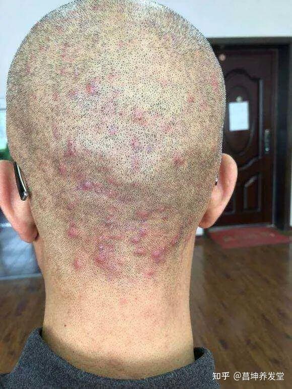 毛囊炎具体是什么样的? - 知乎