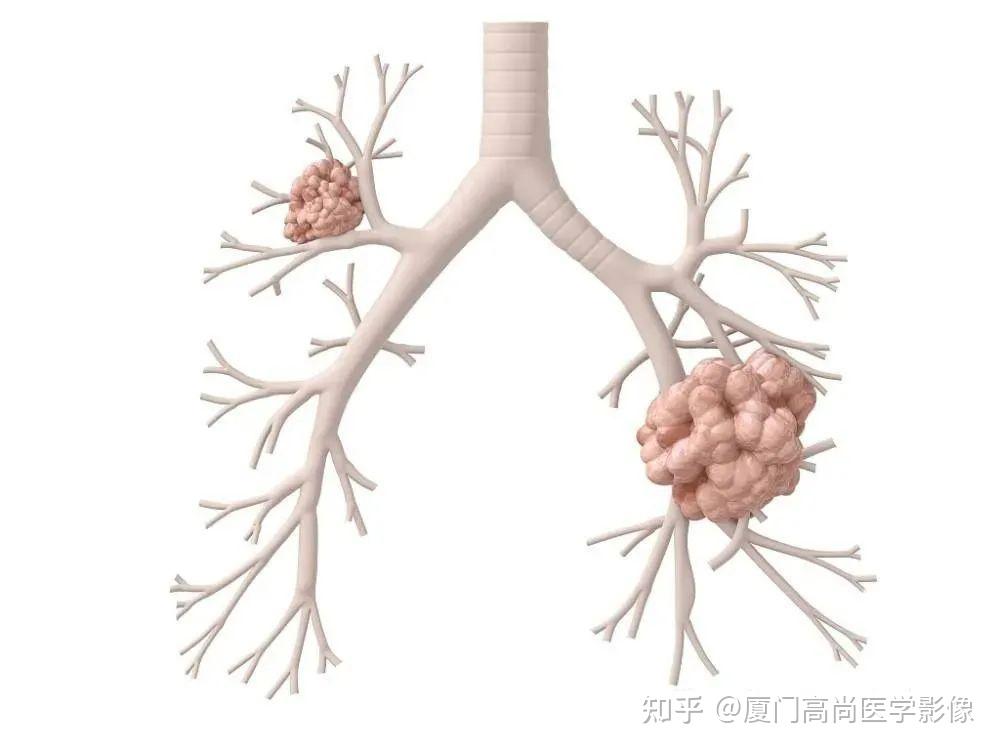 【高尚健康】肺部陈旧性病变会发展为肺癌吗?