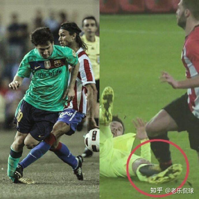 当梅西带球时,对方球员放铲,通过慢镜头可以看出,梅西的脚踝已经变形
