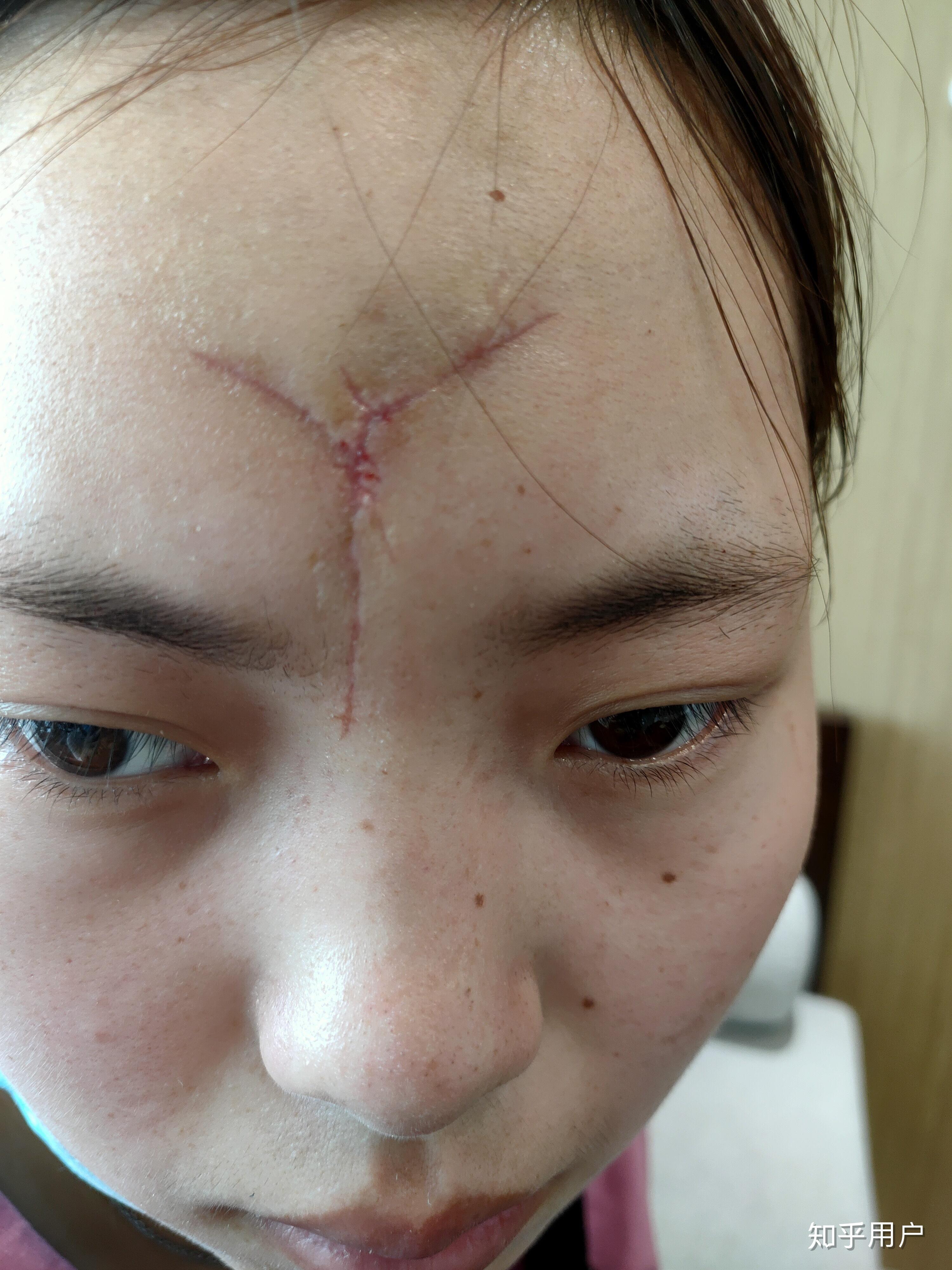 女生脸上有疤是怎样的体验