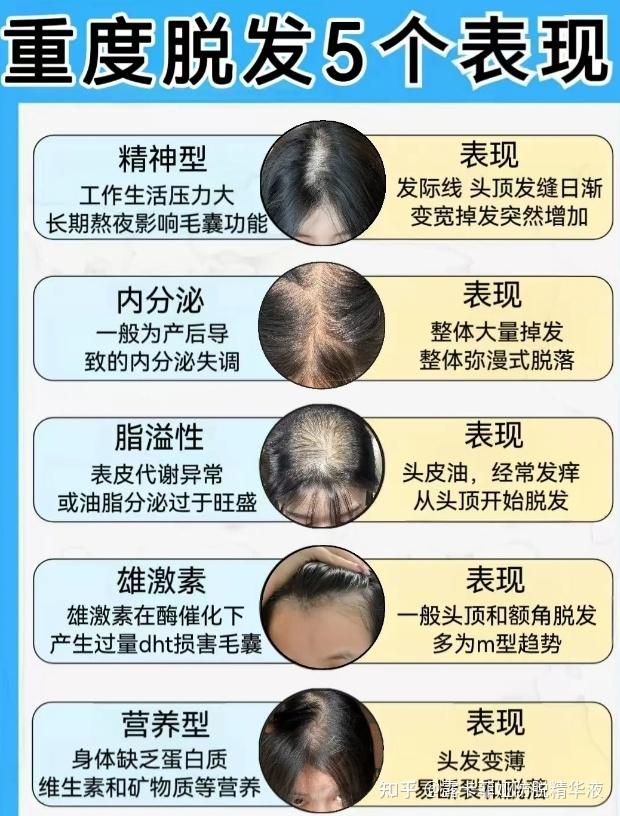 女性脱发怎么治疗看过医生还是很疑惑