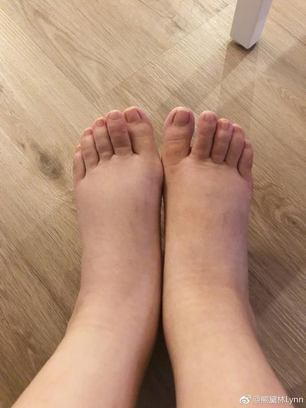 熊黛林晒照自爆产后脚肿像猪蹄产妇如何消除产后浮肿 知乎