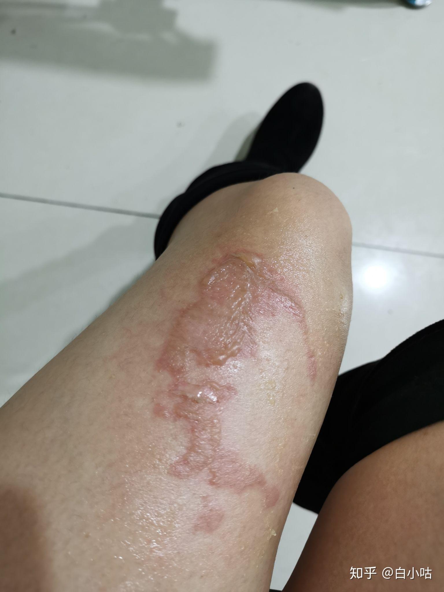 烫伤前后皮肤的具体变化是怎样的? - 知乎