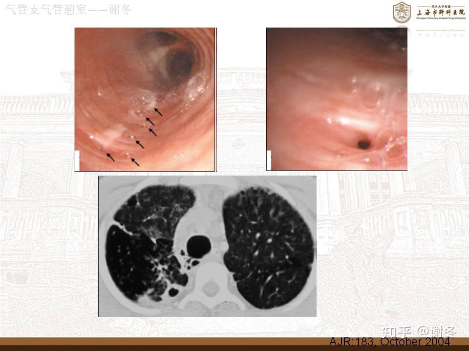 气管憩室是什么疾病?需不需要治疗?