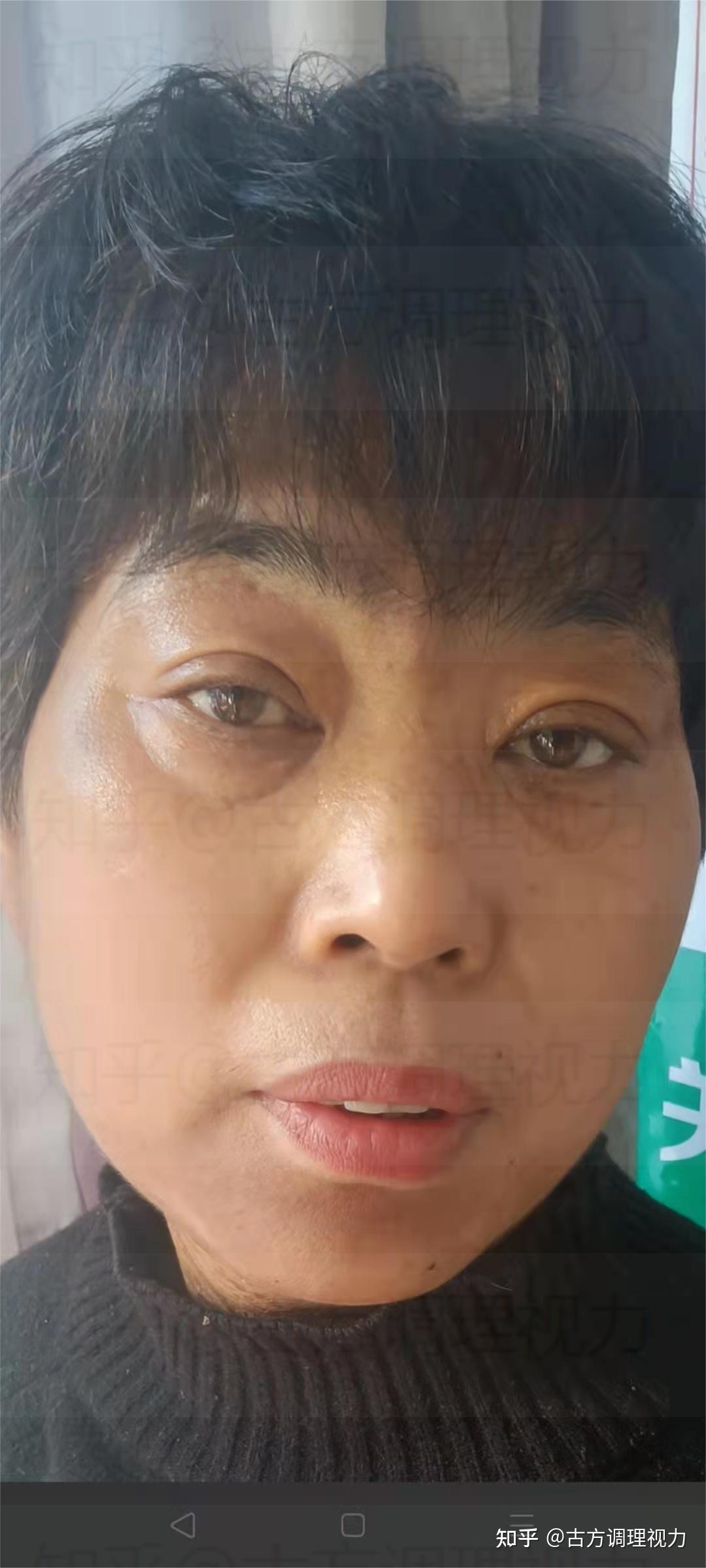 眼睛下面长了小肉瘤,请问是什么?该怎么去除?