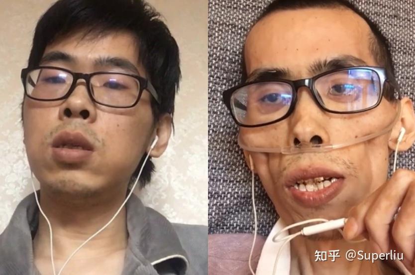 34岁抗癌博主离世一年时间枯瘦如柴