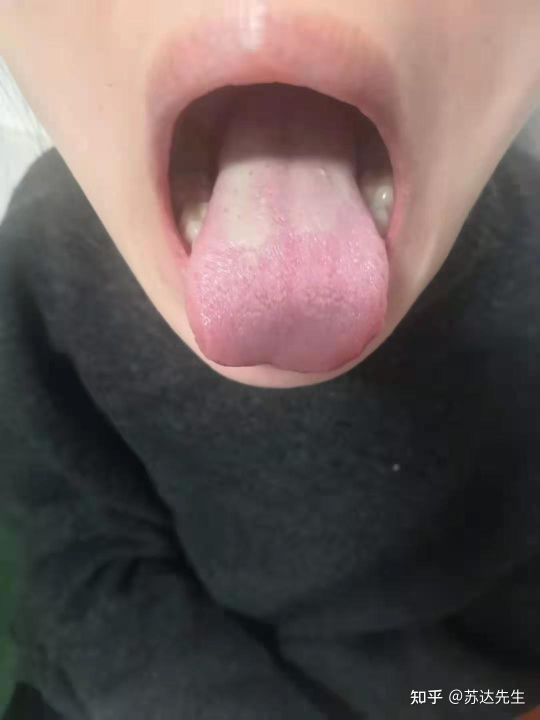 刘渡舟柔肝滋胃饮治肝豆状核变性患者案例分享