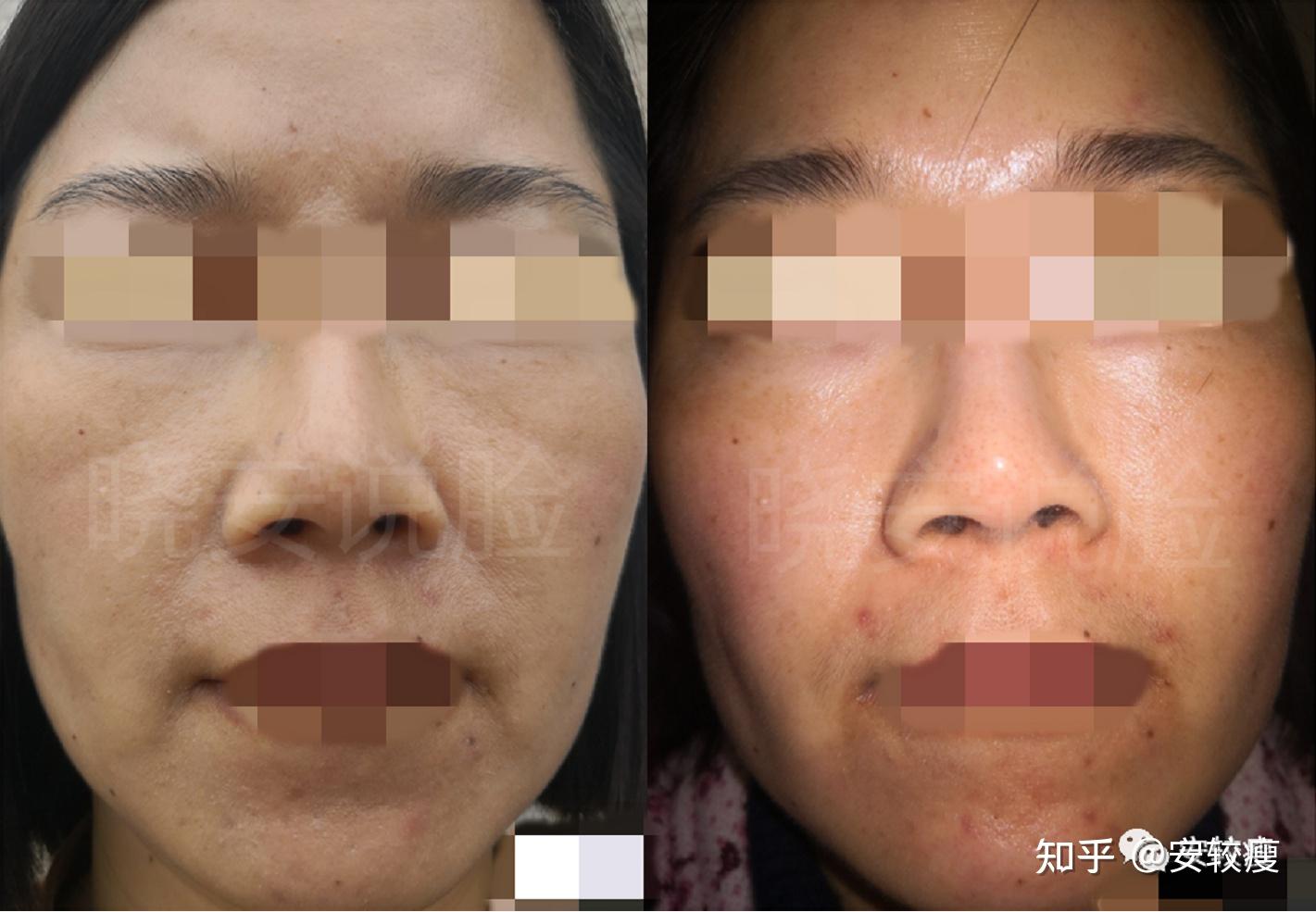 只靠个补水就淡化了印第安纹的神奇案例来了