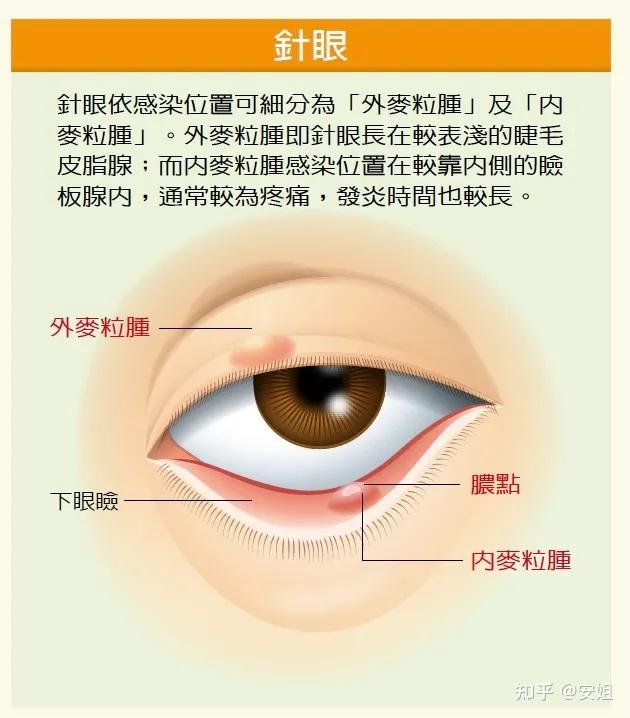 角眼怎么治好的最快图片