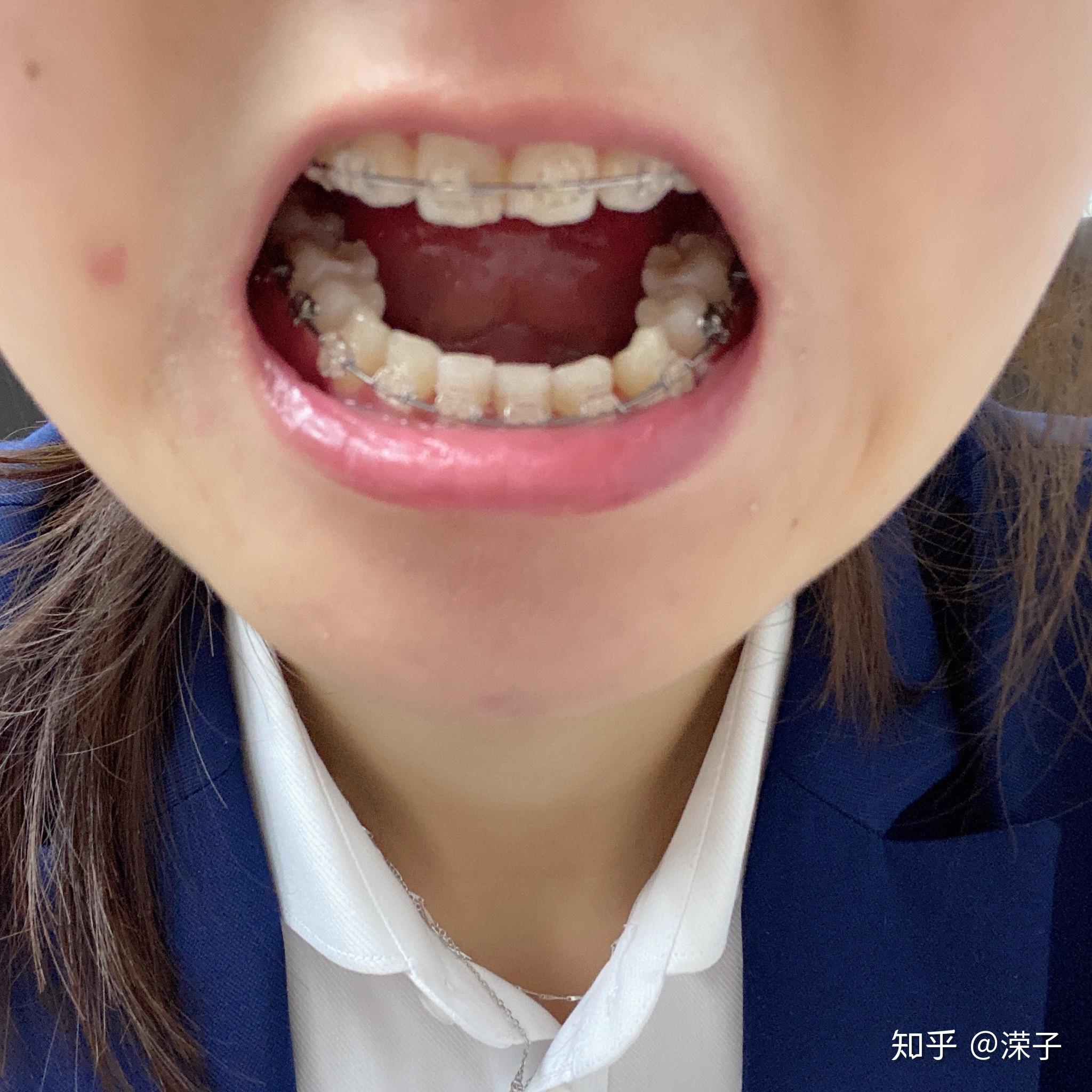 20岁的女生,矫正牙齿戴牙套,还要拔四颗牙是什么感觉啊,担心会不会有