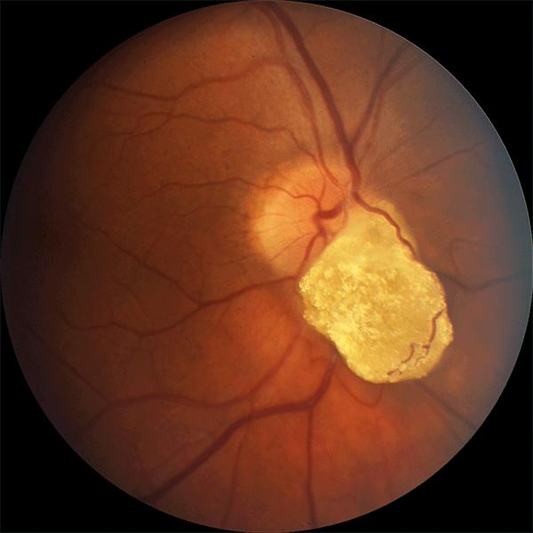 视网膜肿瘤性疾病——4,视网膜星形细胞错构瘤