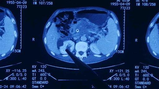 肝硬化肝癌的增强ct图像