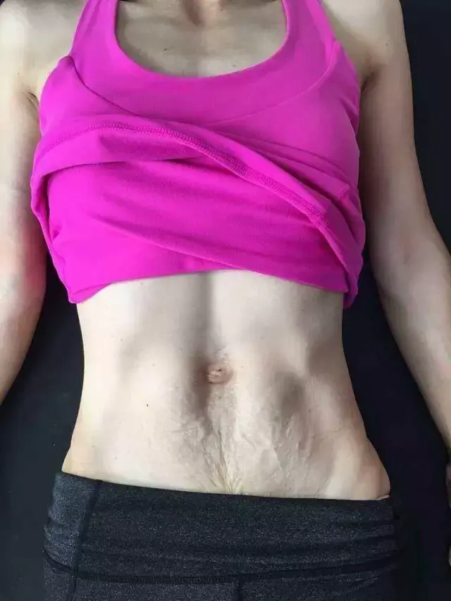 腹直肌分离,男性肚大也中枪.(上海星能运动学院运动健身美文)