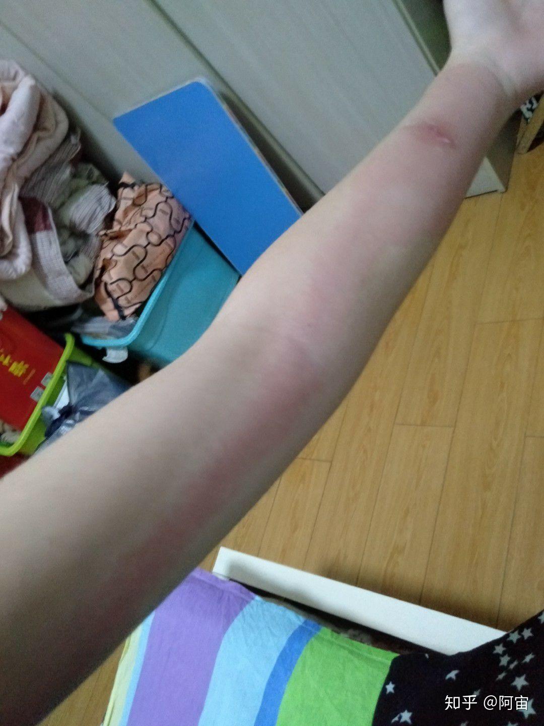 为何被蚊子叮过之后会整条手臂类似于顺着血管都红了? - 知乎