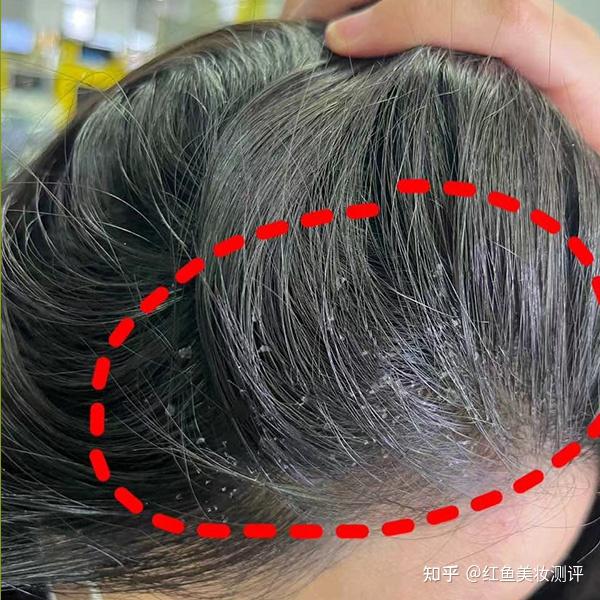 为什么吹头发会出现头皮屑？如何避免？?头皮护理选择技巧 - 知乎