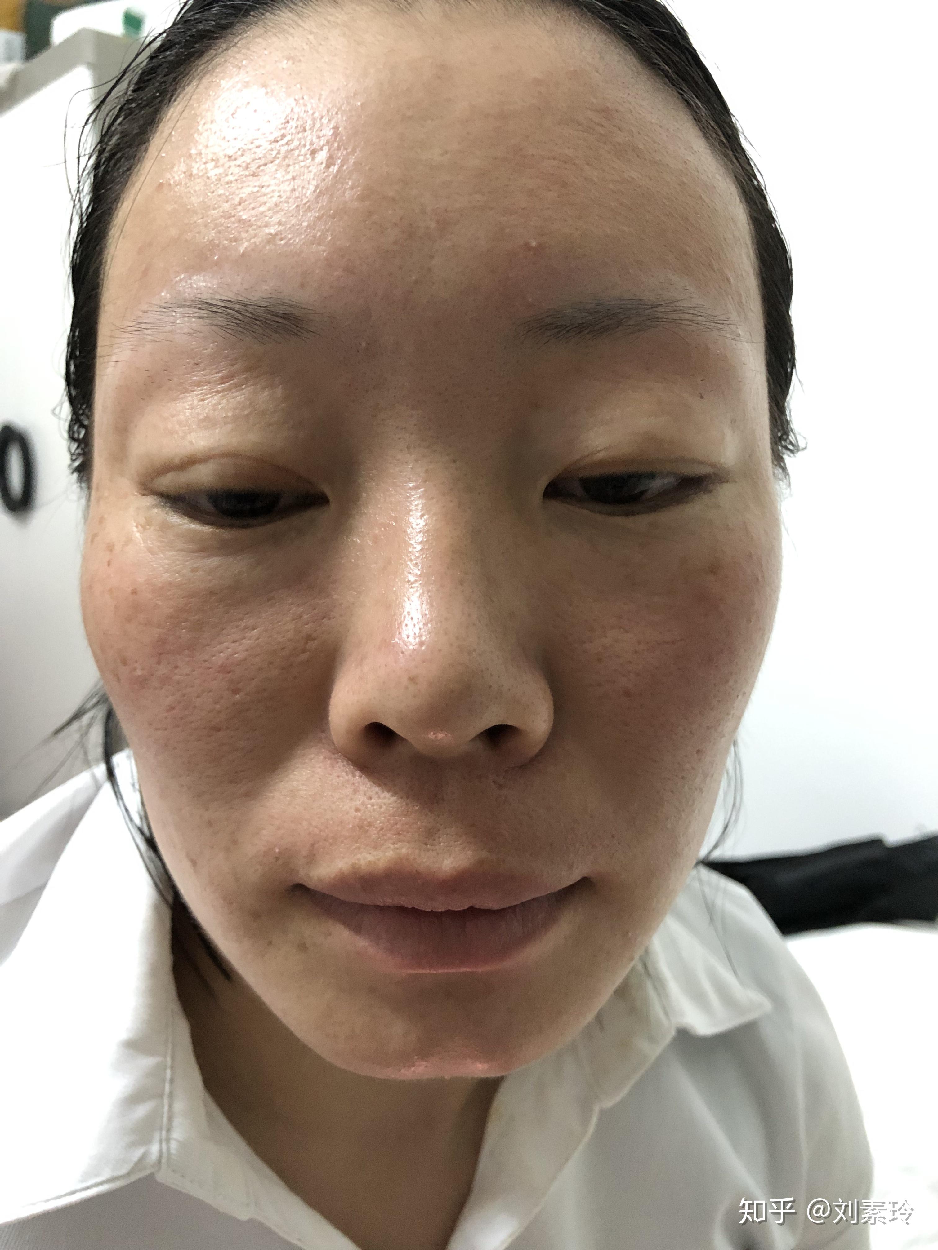 北方人来广州皮肤暗黄了,后来又过敏了是怎么回事?救救我这张脸吧!