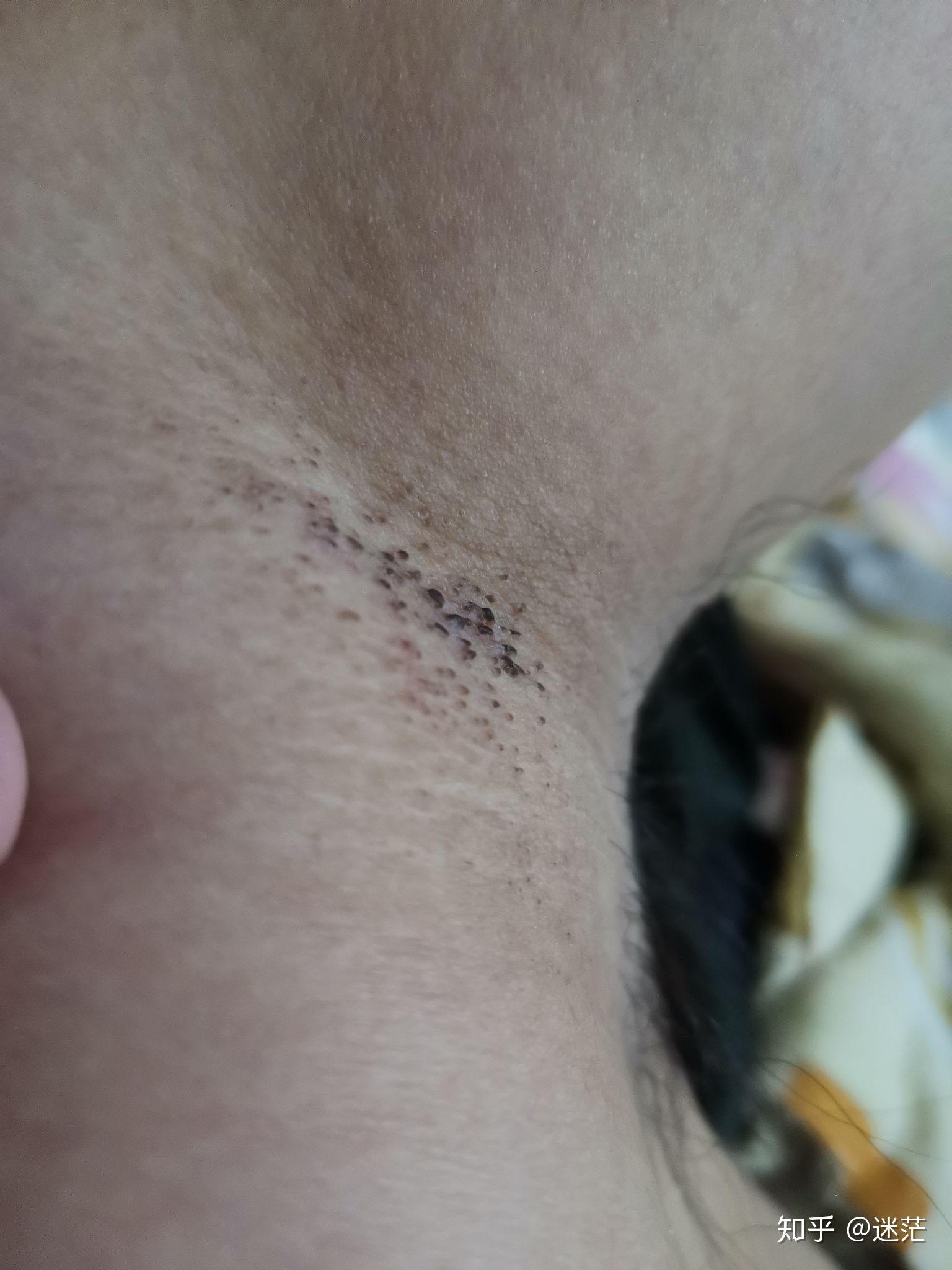 腋下的毛孔中有种黑色的横着的可挤出挤出成扁形的物