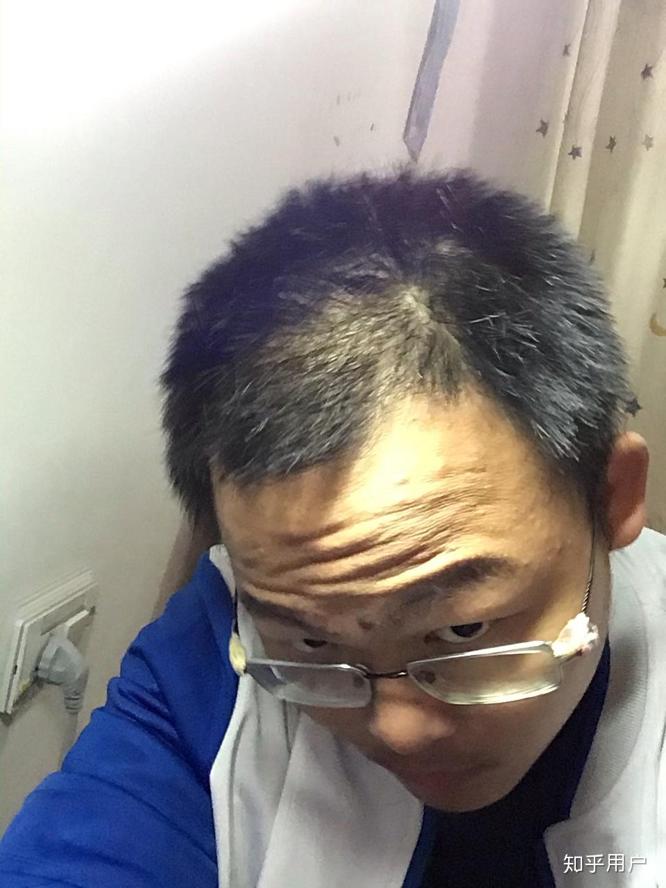 高中生掉头发怎么办? - 知乎