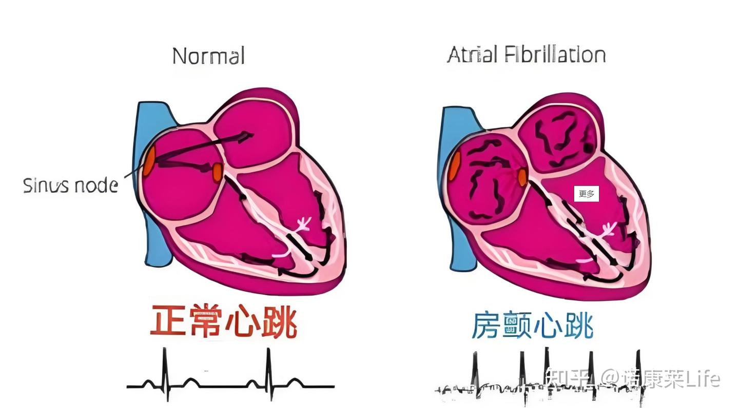 体检上房颤VS室颤有什么区别? - 知乎