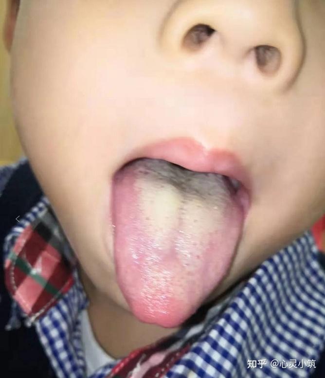 舌象分析:小儿因积食引起发烧