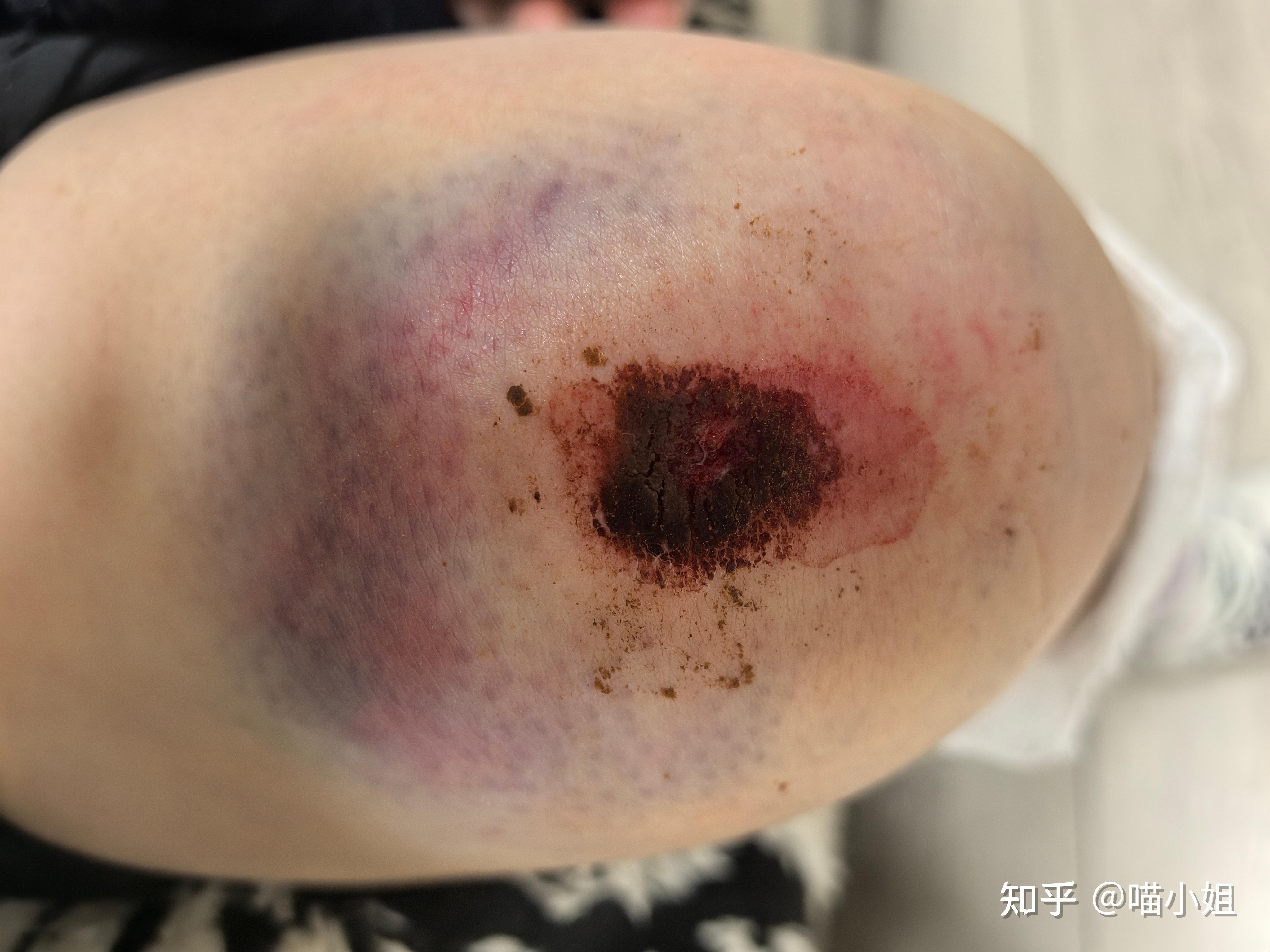 骑电动车摔伤膝盖怎么处理伤口附前期所有错误惨痛的操作