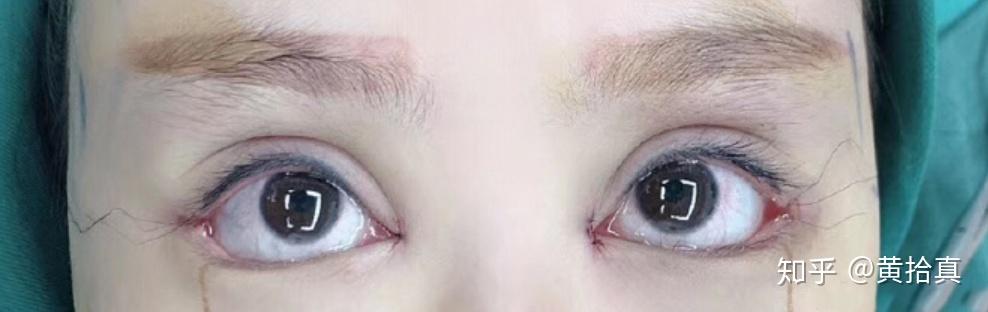 眼睑下至手术回缩与实际效果问题