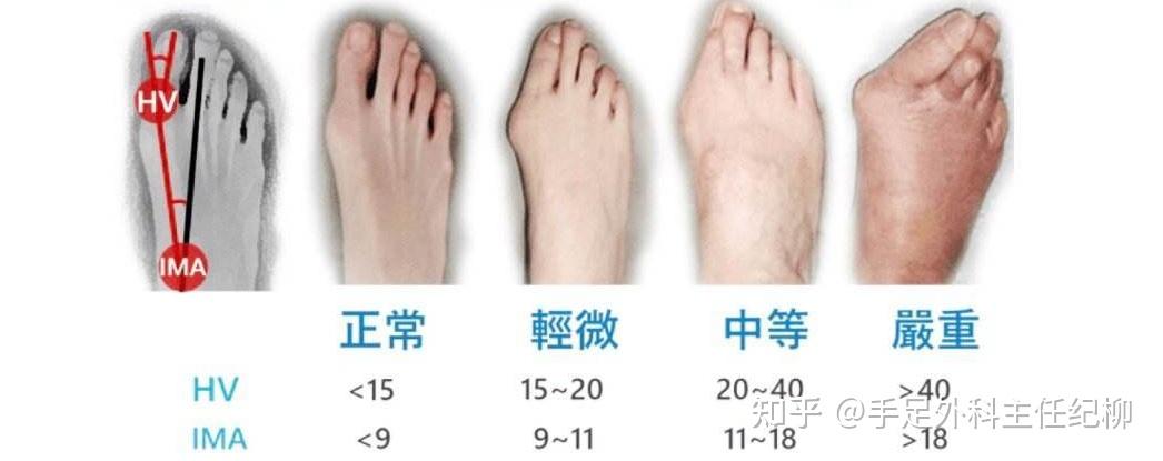 这些跟拇外翻有关的小tips你试过吗