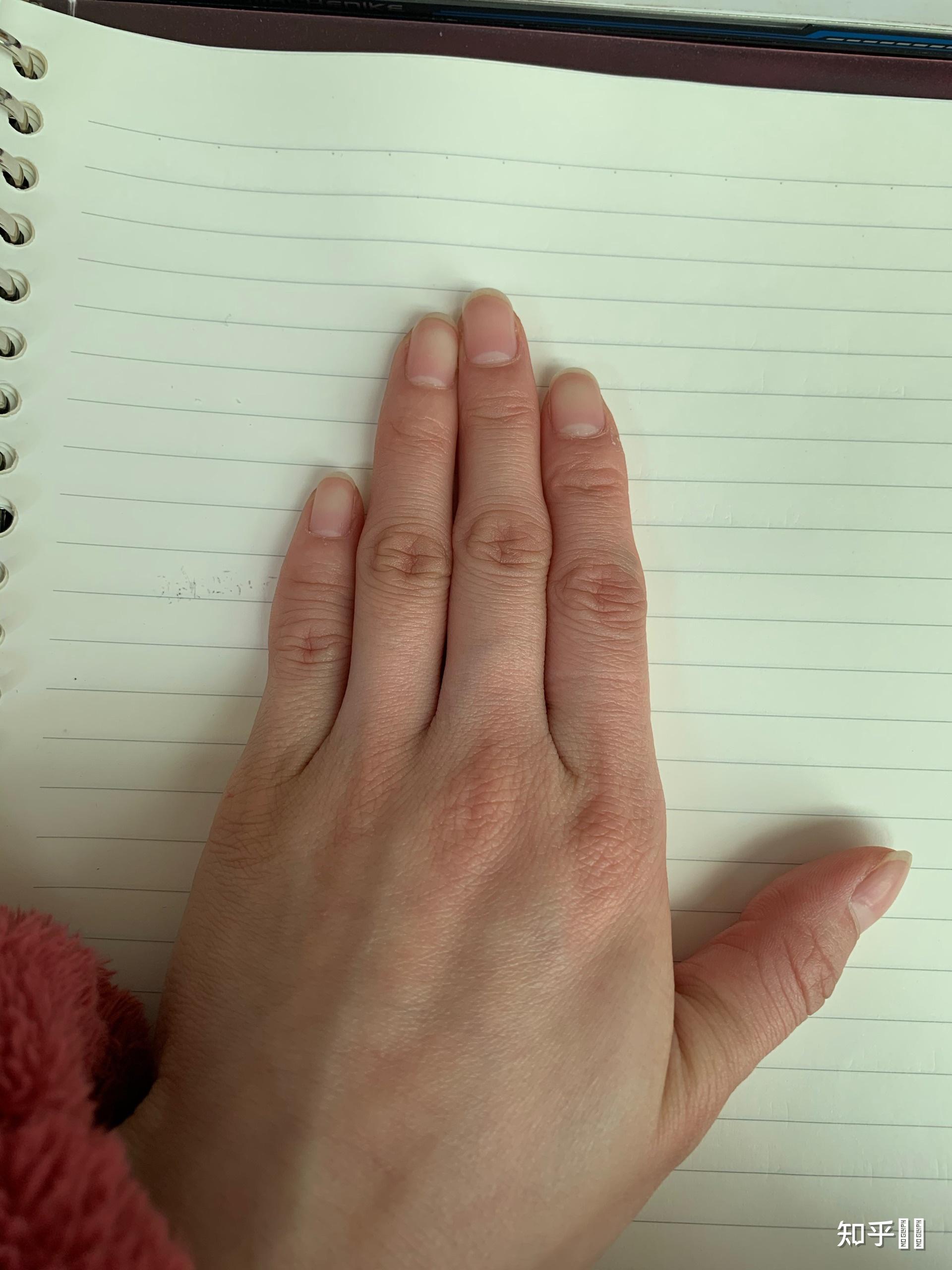左右手除了中指,其他手指的第二节关节都和正常人相反(如图) [图片]