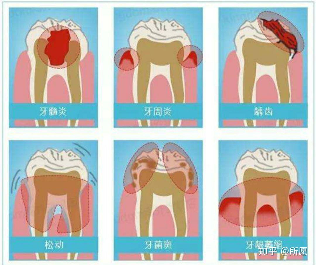 牙病有哪些以及预防牙病的措施