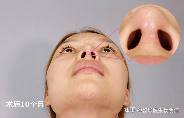 鼻综合术后会留下疤痕吗