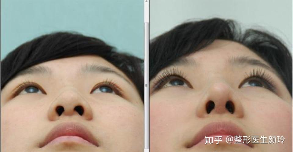 鼻托怎么调都不合适,鼻托怎么调整合适