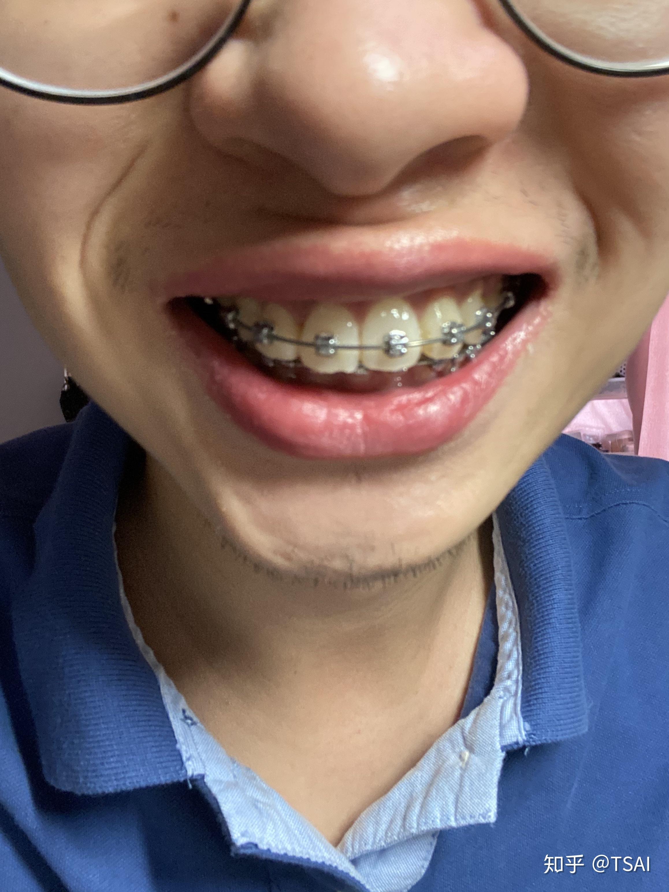 男生矫正牙齿是怎样一种体验？ - 知乎