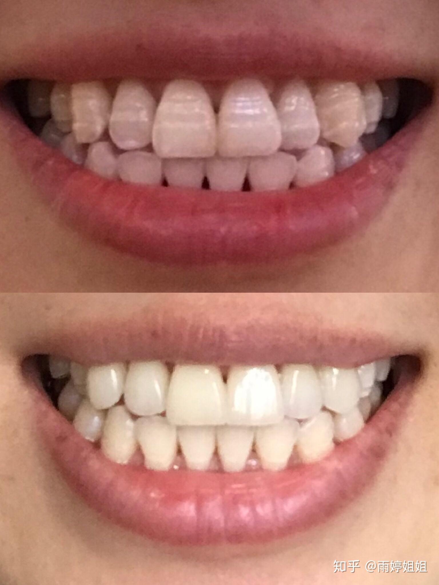 美容牙齿贴面 完美无瑕的美尽在 曼谷微笑牙科诊所